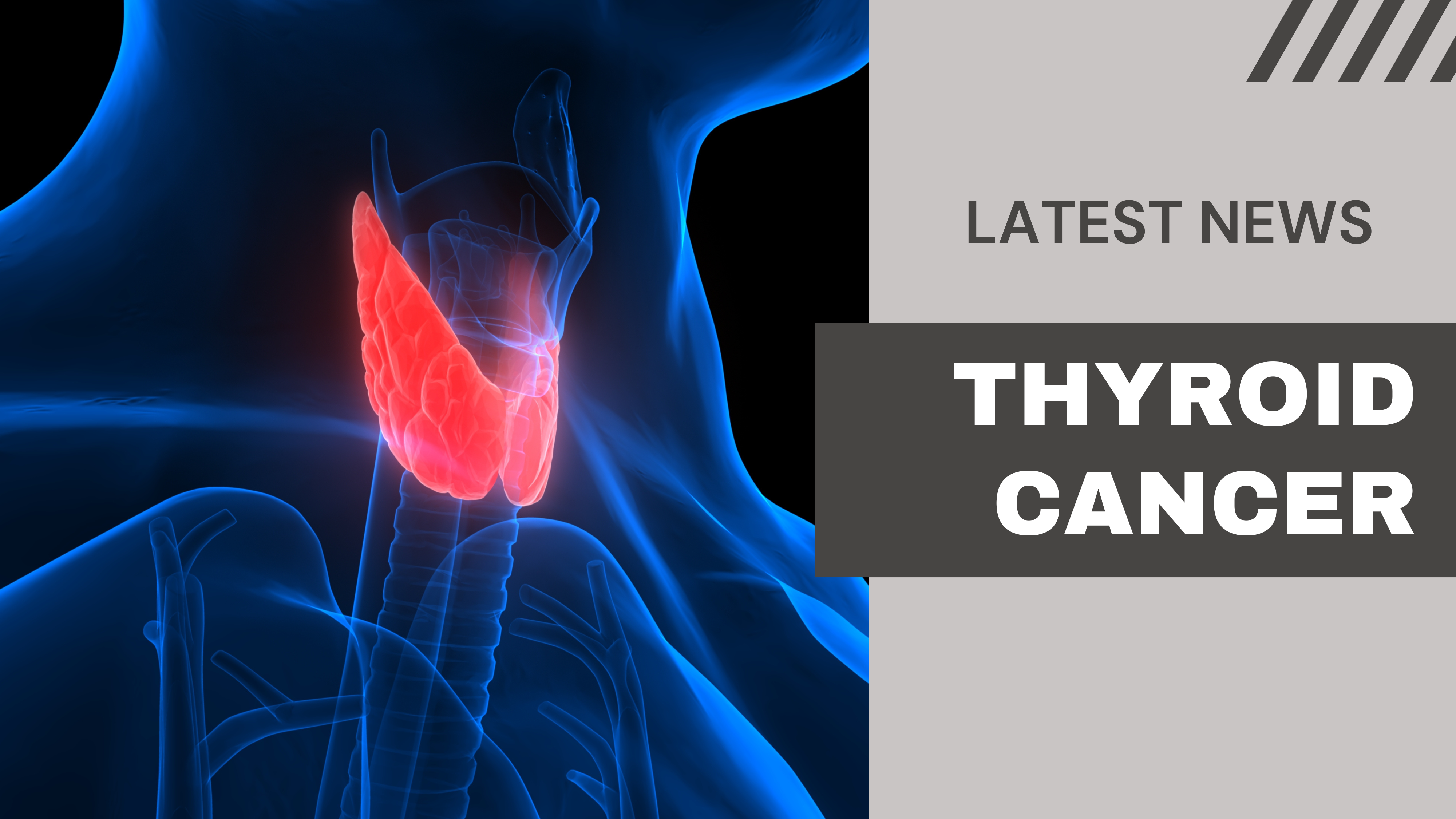 Thyroid Cancer