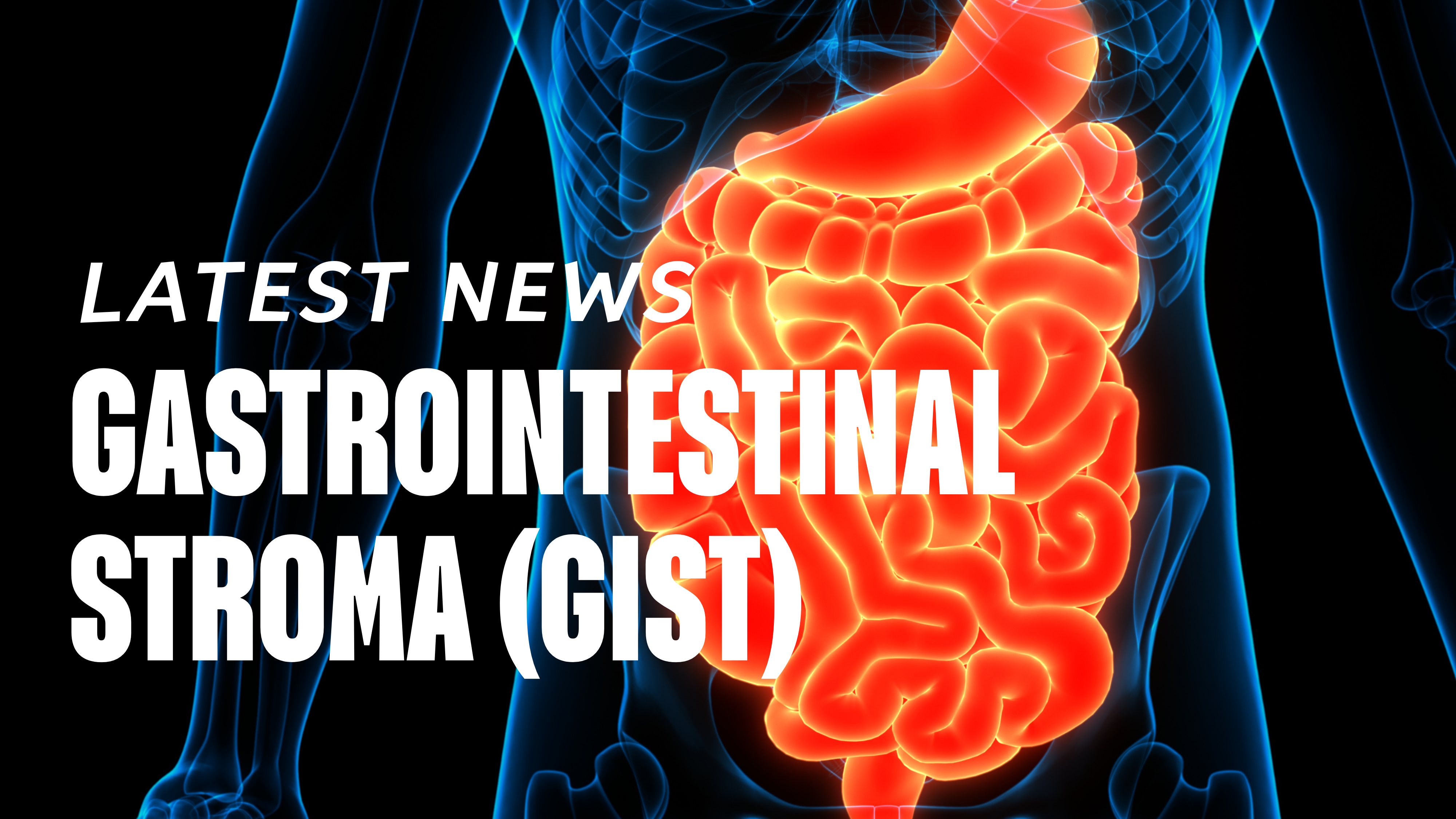 GastroIntestinal Stroma (Gist)