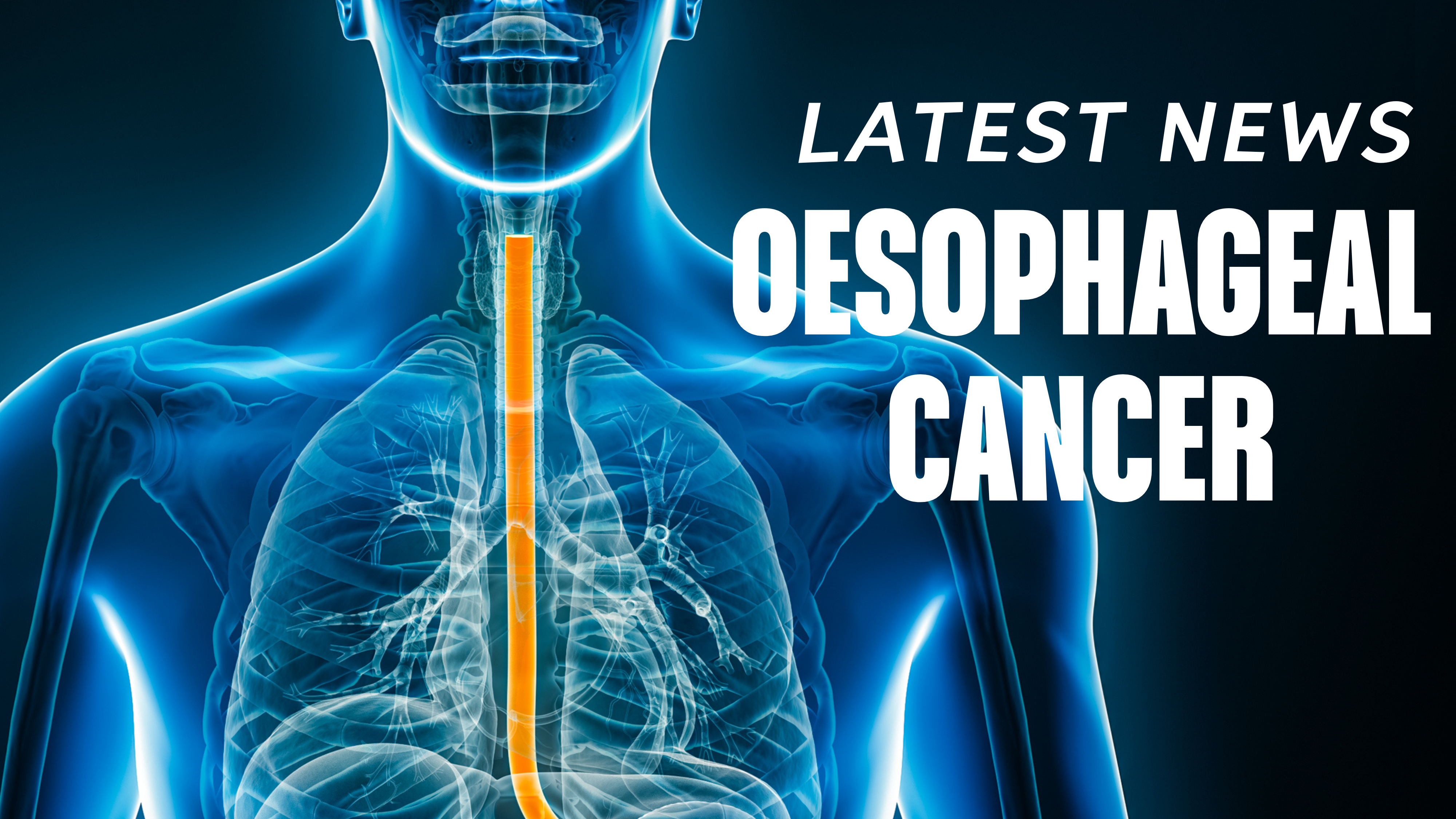 Oesophageal Cancer - Latest News, Latest Research | CANCERactive