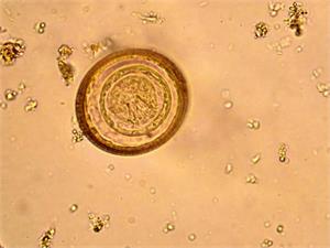 Pinworm drug, Mebendazole, and cancer - TNBC,  GBM, pancreatic and colon