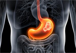 Stomach Cancer - Latest News, Latest Research | CANCERactive