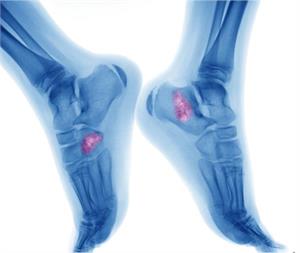 An Overview of Multiple Myeloma - symptoms, treatments and alternative therapies