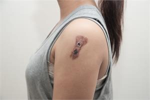 An Overview of Melanoma and Skin Cancer - symptoms, causes and treatment alternatives