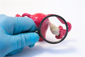 Alternative Ovarian Cancer Treatment