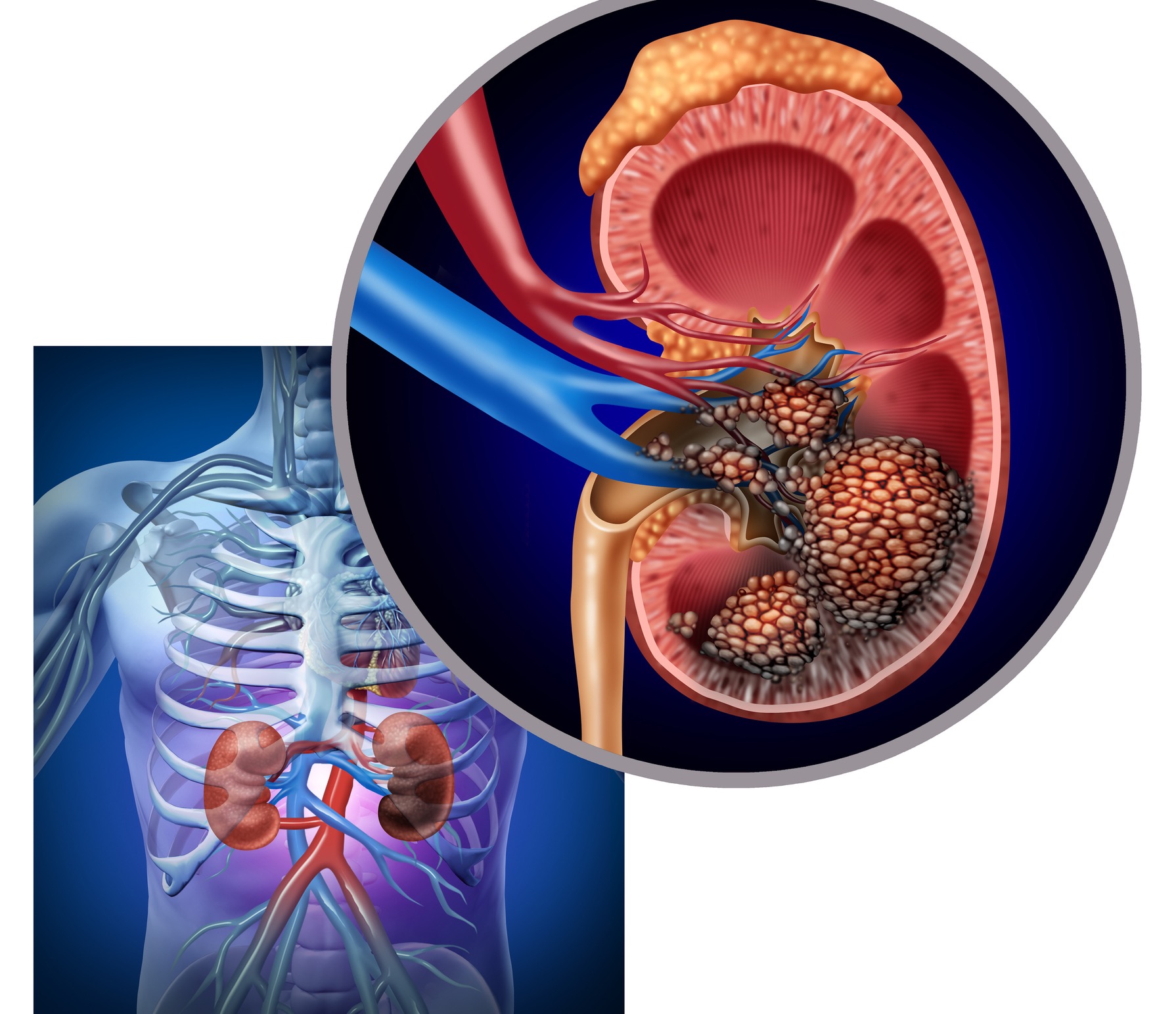 An Overview of Kidney Cancer - symptoms, causes and treatment alternatives
