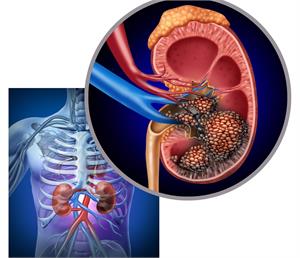 An Overview of Kidney Cancer - symptoms, causes and treatment alternatives