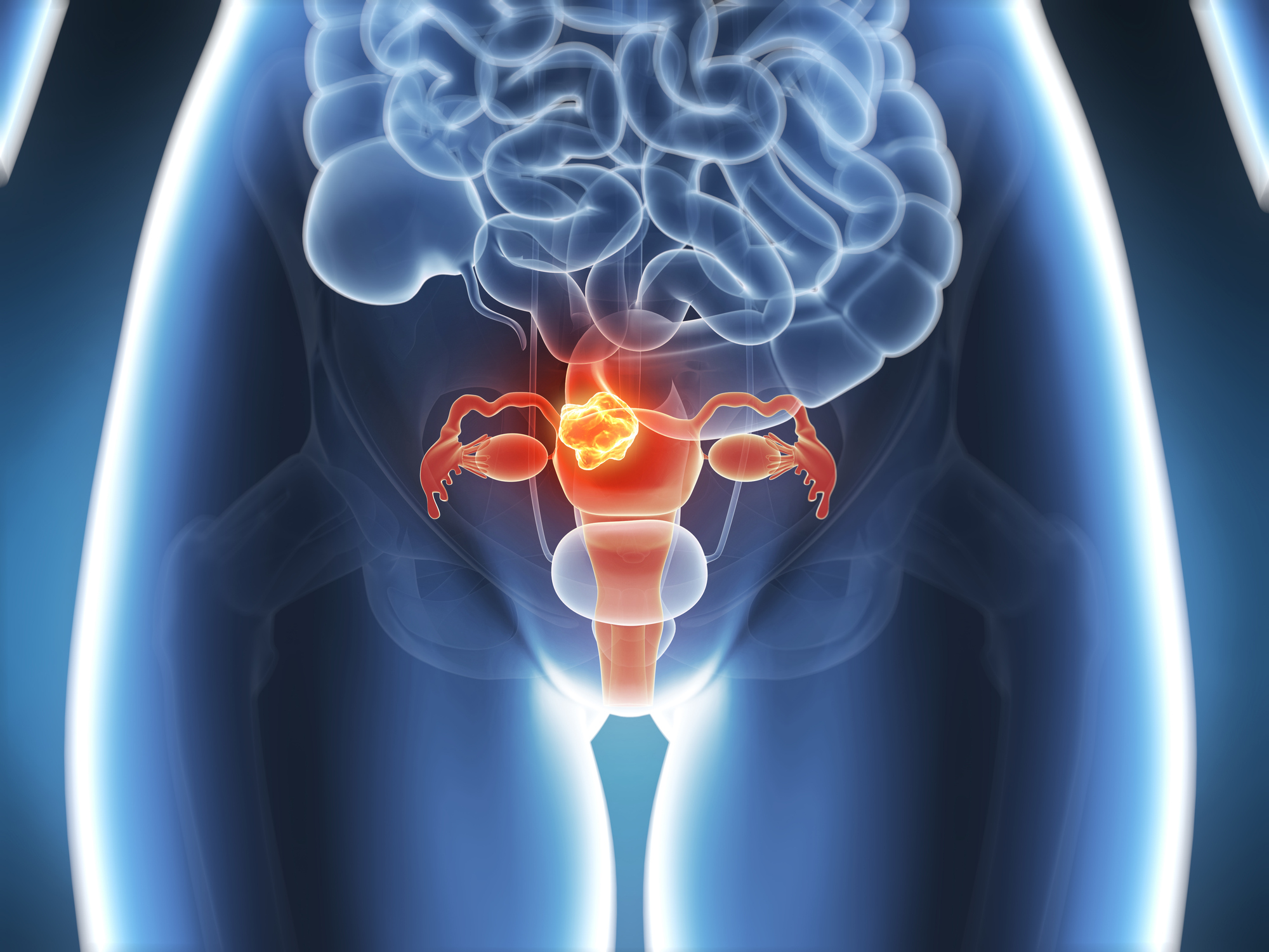 Endometrial or Womb Cancer - Latest News, Latest Research | CANCERactive