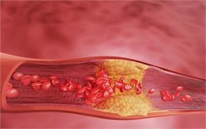 10 supplements to reverse the calcification of arteries?